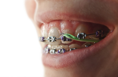 What Rubber Bands on Braces Do